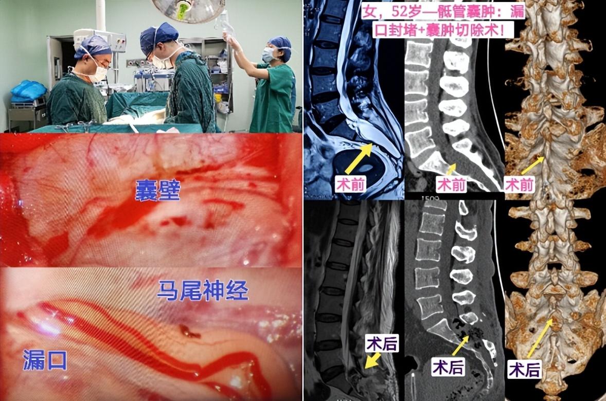 骶管囊肿最新治疗方法,最新骶管囊肿治疗技术