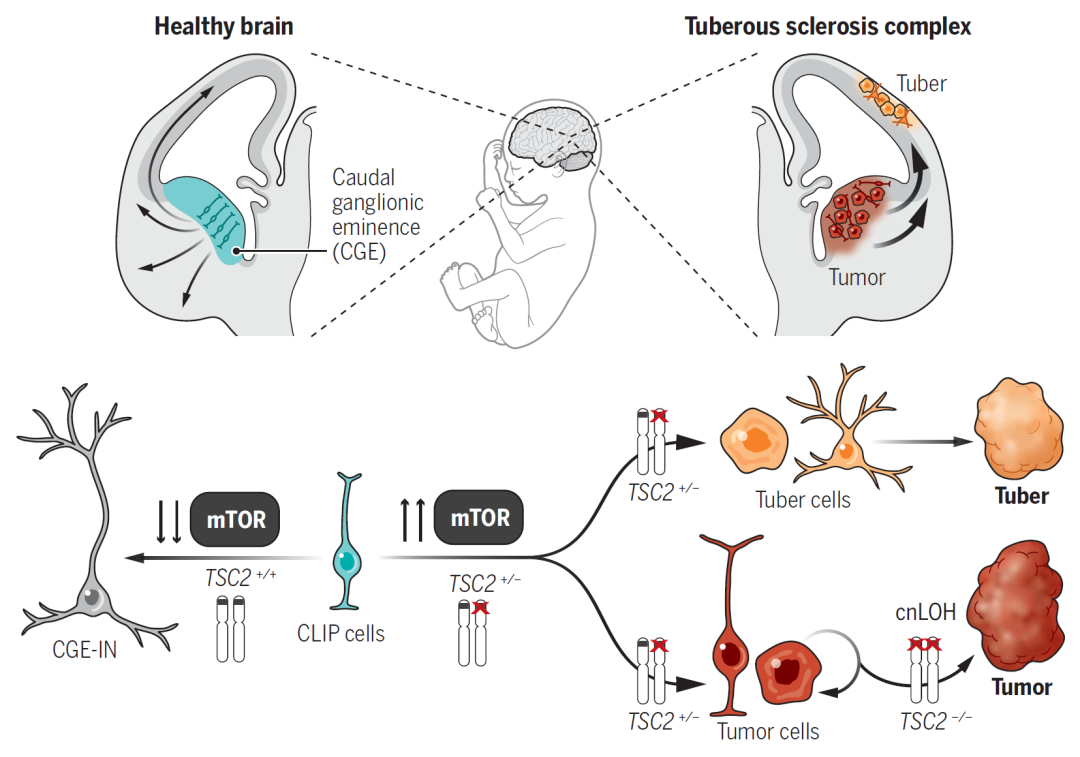 结节性硬化症最新研究,“结节性硬化症前沿进展揭示新动态”