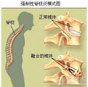 强直最新进展,直击强直性脊柱炎最新治疗突破