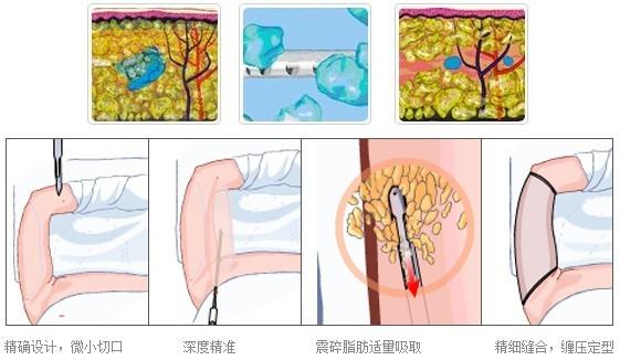 最新吸脂手术方法,最新脂肪溶解技术